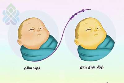 یرقان در نوزادان.
آموزش مراقبت از یرقان نوزادان 