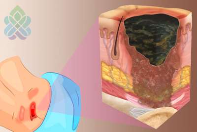زخم بستر چیست و چه مراقبتهایی لازم دارد 
