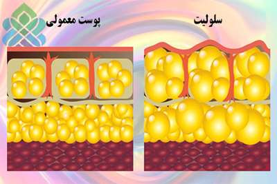 مراقبت در سلولیت 