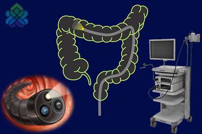 توصیه‌های مهم در کولونوسکوپی
کلونوسکوپی 