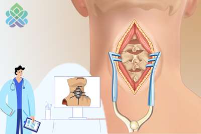 مراقبت پس از جراحی گردن 