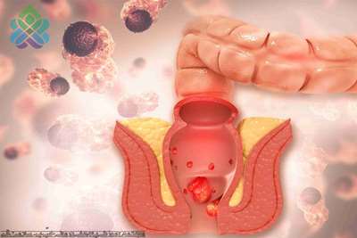 هموروئید یا بواسیر 