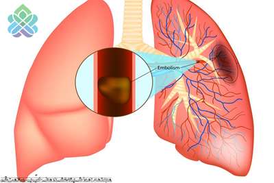 آمبولی ریه 