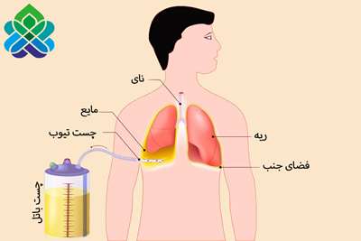 مراقبت از چست تیوب 