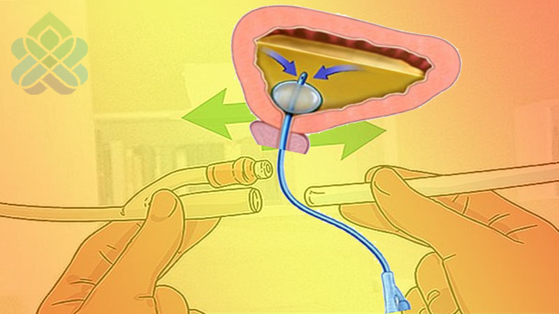 مراقبت از سوند ادراری