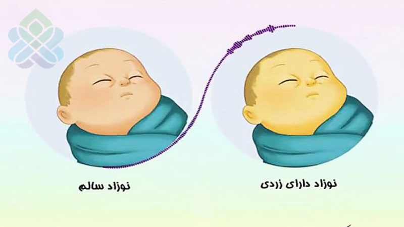 آموزش والدین در مراقبت از یرقان نوزادان.