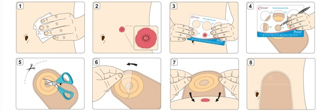 مراقبت از استومی و کلستومی تعویض کیسه کلستومی