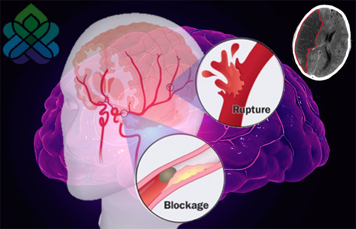 سکته مغزی چیست ، علل سکته مغزی چیست ، درمان سکته مغزی ، انواع سکته مغزی ، بروز سکته مغزی ، آموزش به بیمار در سکته مغزی ، سعید اسپنانی