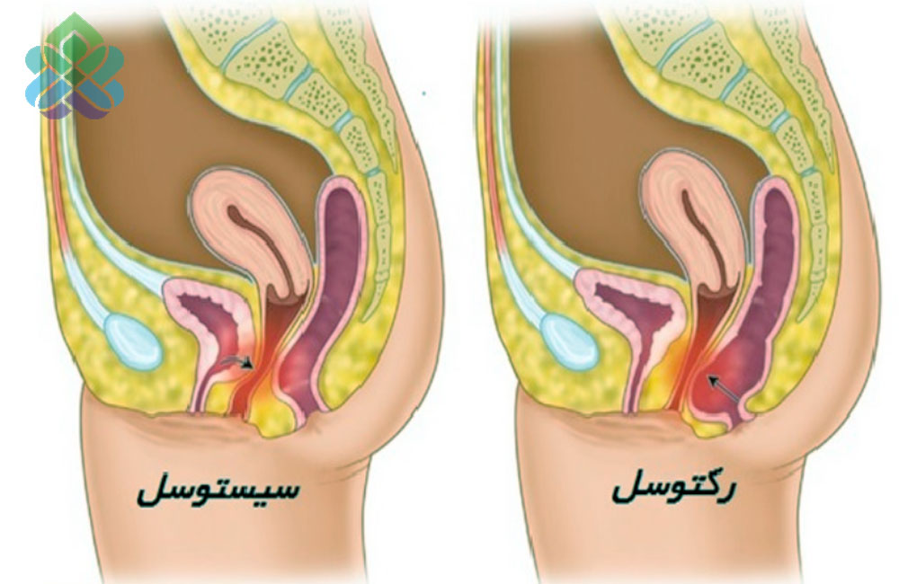 سیستوسل و رکتوسل
