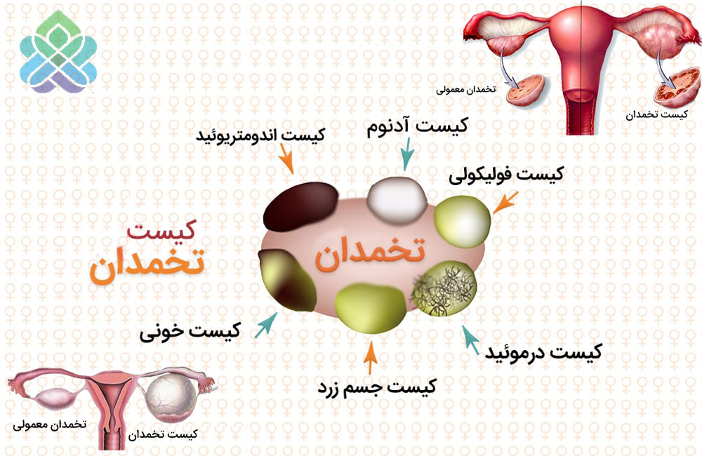 مجتمع خیرین سلامت - کیست تخمدان