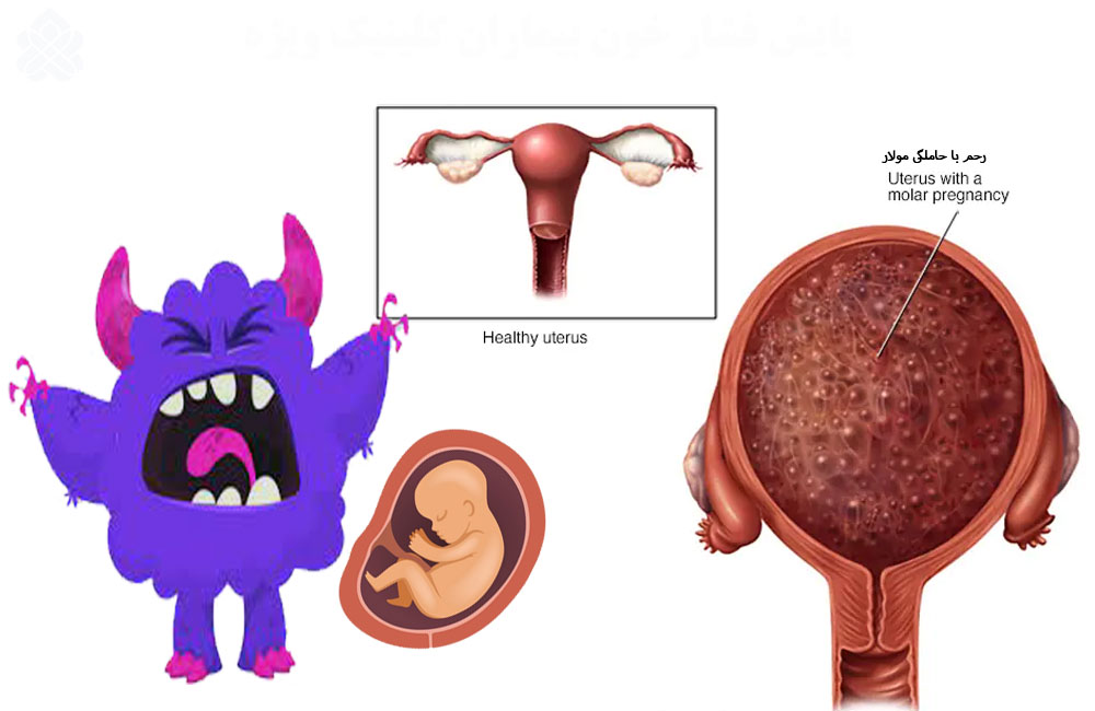 بچه خوره، انگورک، مول هیداتیفرم، حاملگی مولار