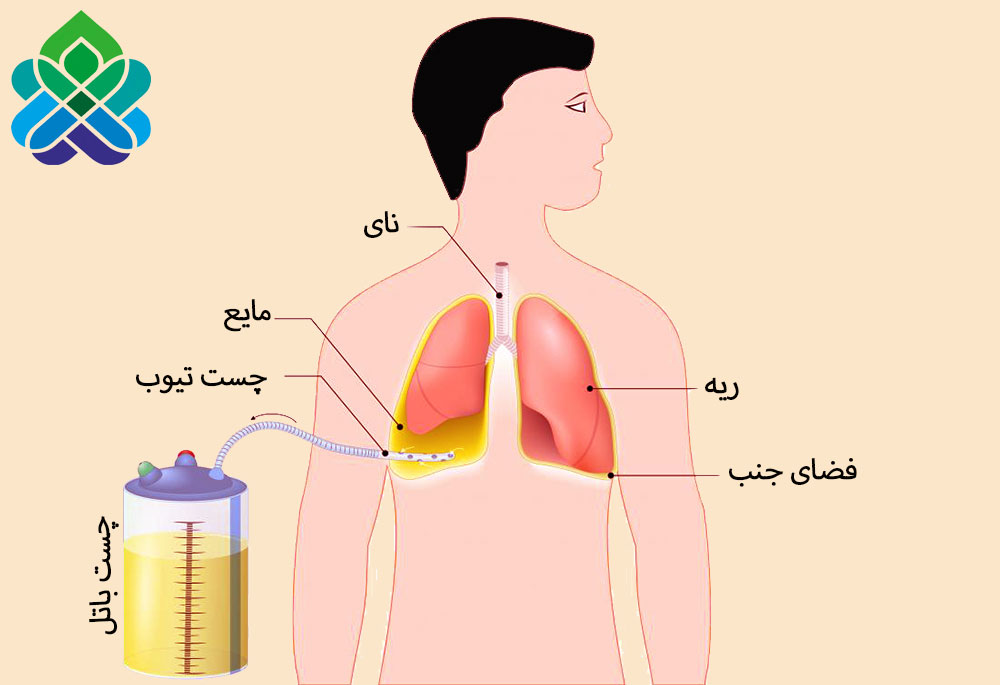 چست تیوب چیست و مراقبتهای لازم در آن چگونه است چگونه از چست تیوب مراقبت کنیم مراقبتهای لازم پس از خارج کردن چست تیوب نحوه گذاشتن چست تیوب